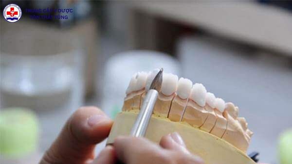 kỹ thuật phục hình răng là gì