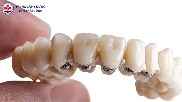 kỹ thuật phục hình răng làm gì